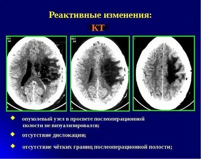 Пневмоцефалия