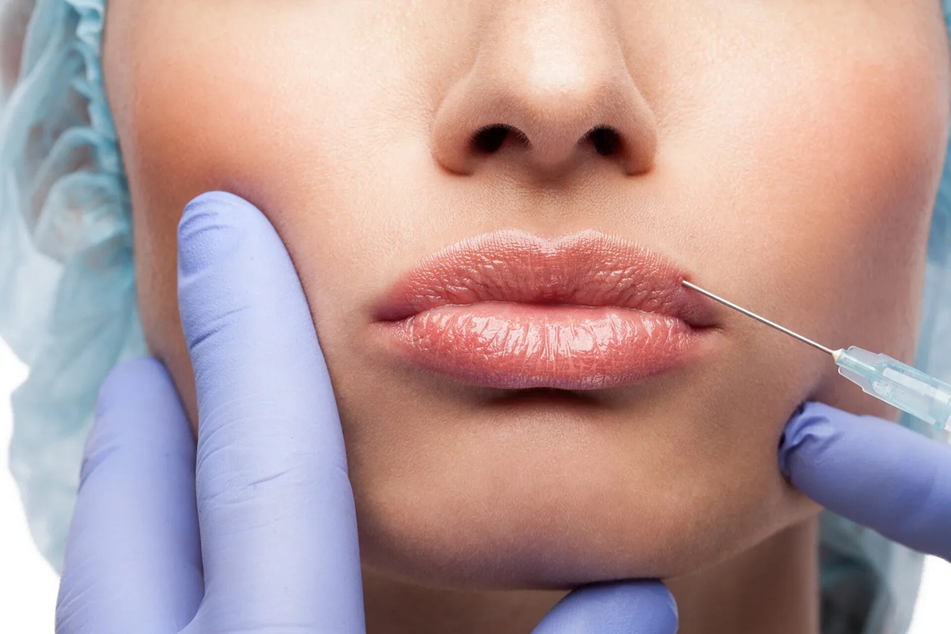 Lip filler