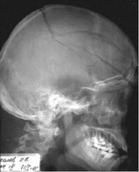 Оскольчатый перелом черепа рентген. Перелом теменной кости черепа рентген. Перелом теменной кости рентген. Перелом костей черепа рентген. Травмы черепа и головного мозга