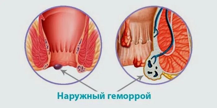 Ноющая боль в заднем проходе