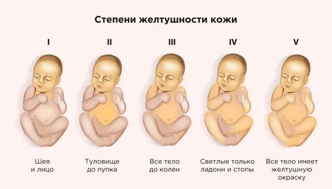 Почему у новорожденного появилась желтушка