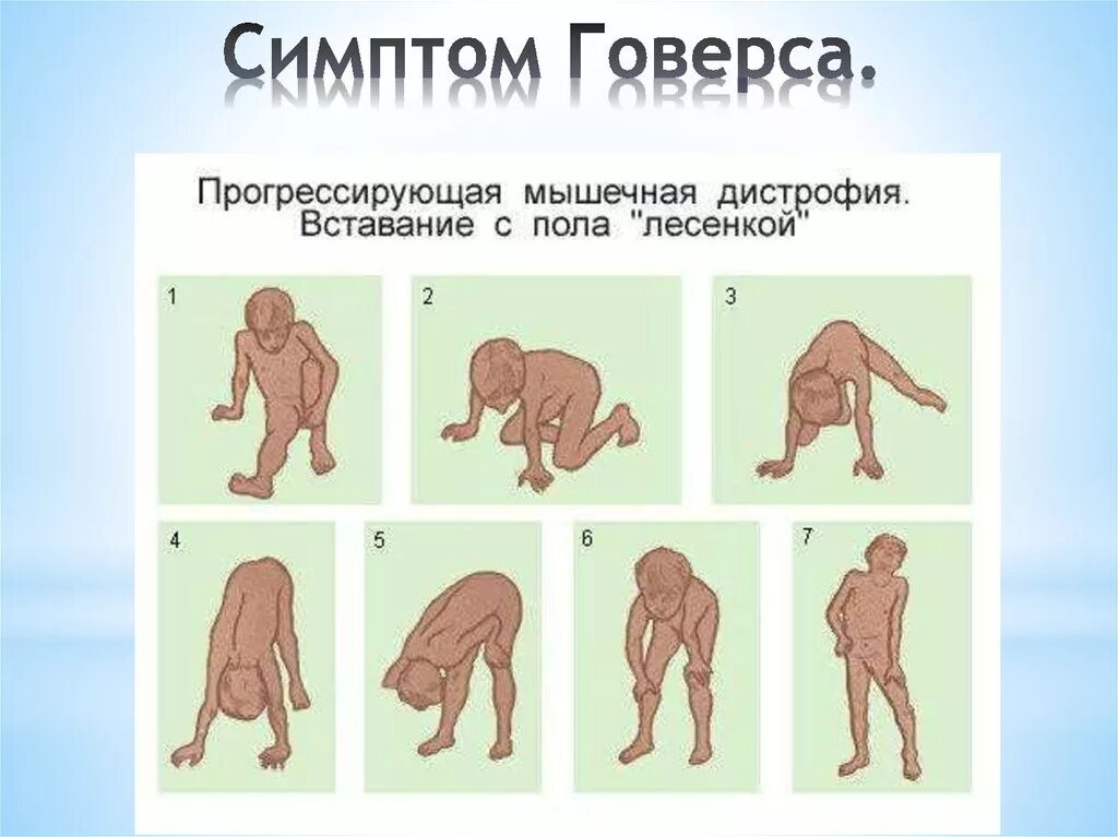 Прогрессирующие мышечные дистрофии классификация. Мышечная дистрофия дюшенна код мкб 10. Прогрессирующая мышечная дистрофия дюшенна. Прогрессирующие мышечные дистрофии (миопатии). Мышечная дистрофия дюшенна проявления.