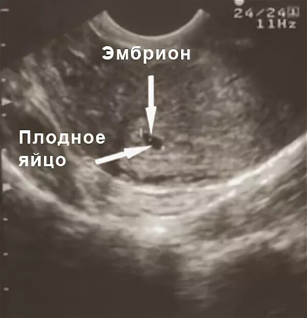 УЗИ плода на 2-3 неделе беременности. Плодное яйцо на УЗИ 3 недели беременности. Как выглядит 3 недельный эмбрион на УЗИ. Как выглядит эмбрион в 2 недели на УЗИ.