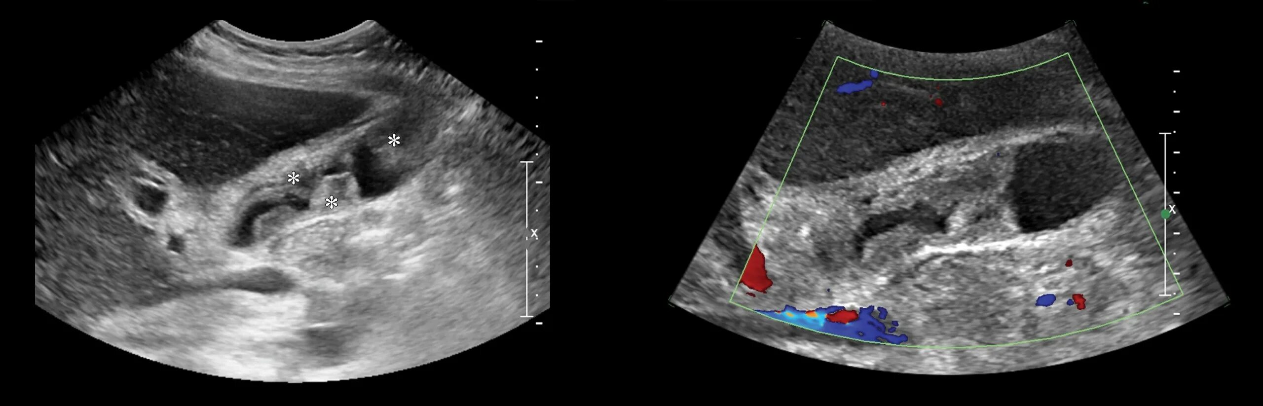 Узи аномалий. Аномалии желчного пузыря на УЗИ. Опухоль желчного пузыря на УЗИ. УЗИ желчного пузыря Диагностер. УЗИ брюшной полости с ЦДК.