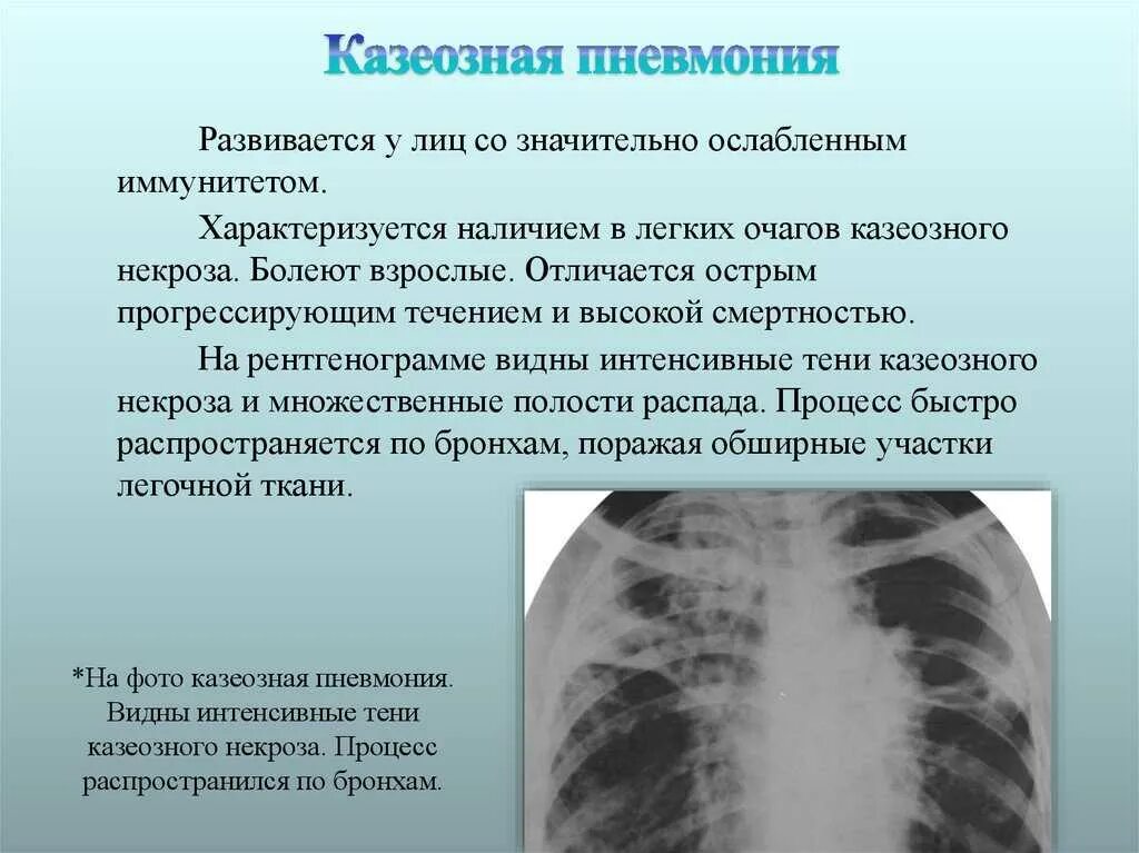 Казеозная пневмония туберкулез. Казеозная пневмония рентген. Казеозная пневмония аускультация. Лобарная казеозная пневмония рентген.