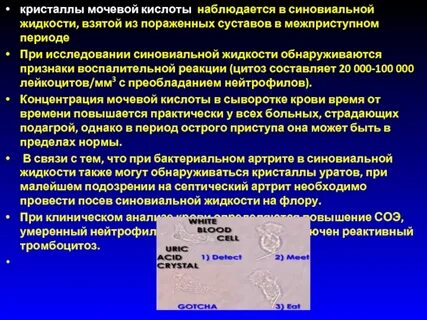 Кристаллы мочевой кислоты в суставах