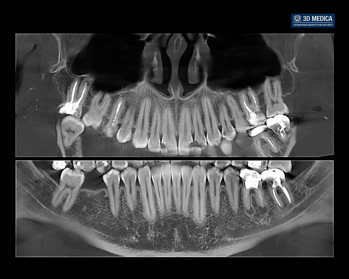 Где сделать кт зуба. 3д КЛКТ зубы. Компьютерная томография челюсти снимок. КЛКТ зубов верхней челюсти.