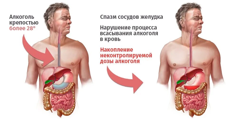 Непроходящая икота при алкогольной интоксикации что делать - фото презентация