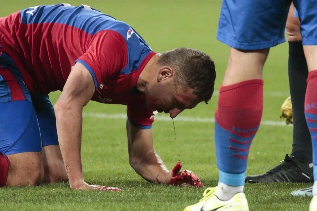 Кровь спортсмена. ЦСКА Сочи травма Чалова. ЦСКА Сочи Чалову разбили нос. Федор Чалов разбитый нос.