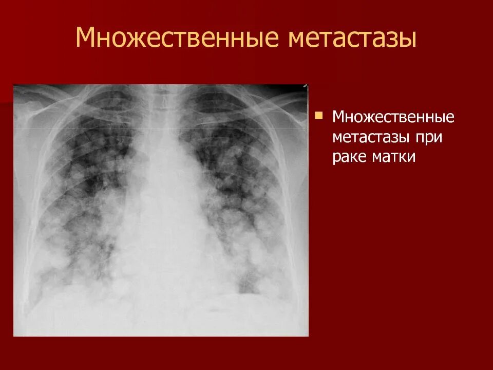 Какой рак метастазирует. Метастатические опухоли легких. Метастатическое поражение легких рентген. Метастазы легких рентгенодиагностика.