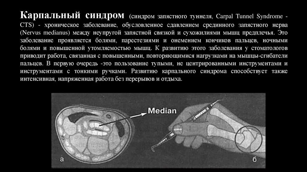 Синдром карпального туннеля. Эргономика в стоматологии. Синдром запястного канала на УЗИ. Синдром карпального канала мкб 10