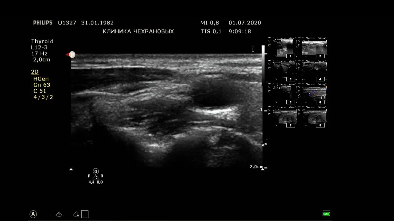 Можно ли перед узи щитовидной железы есть. Атлас УЗИ щитовидной железы. УЗИ щитовидной железы Tirads. Tirads4 щитовидной железы Tirads 4. Картинки УЗИ щитовидки снимок.