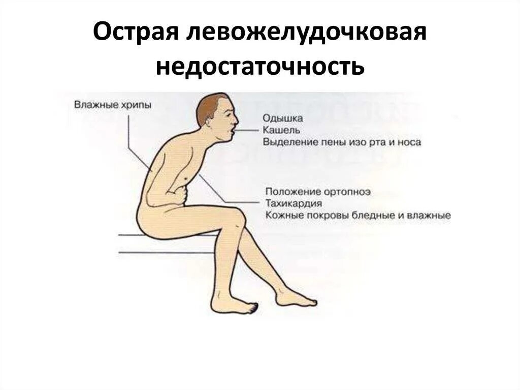 Токсическая одышка. Патогенез развития отека легких. Клинические признаки отека легких. Отёк лёгких симптомы. Токсическая одышка.