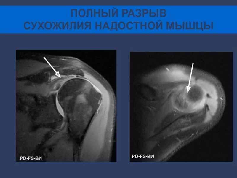 Операция разрыва сухожилия надостной мышцы. Надостная мышца плечевого сустава мрт. Разрыв надостной мышцы мрт. Ретракция сухожилия надостной мышцы. Повреждение надостной мышцы плечевого сустава на мрт.