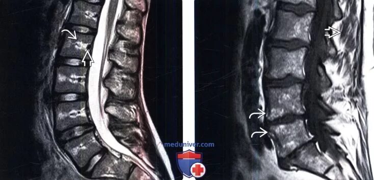 Реконверсия костного мозга мрт позвоночника. Жировая дегенерация позвонков на мрт что это. Жировая дегенерация костного мозга мрт. Жировая дистрофия позвонков мрт.