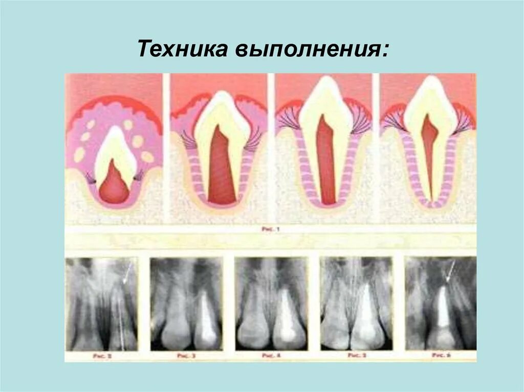 Лечение пульпита с несформированными. Периодонтит постоянных зубов с несформированными корнями у детей.