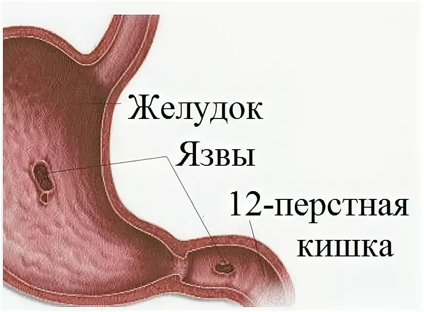 Язва язва двенадцатиперстной кишки и желудка. Язвенная болезнь желудка и 12 п кишки. Язва желудка и 12 ти перстной кишки. Язва 12 ти