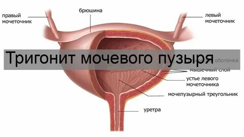Идиопатический цистит