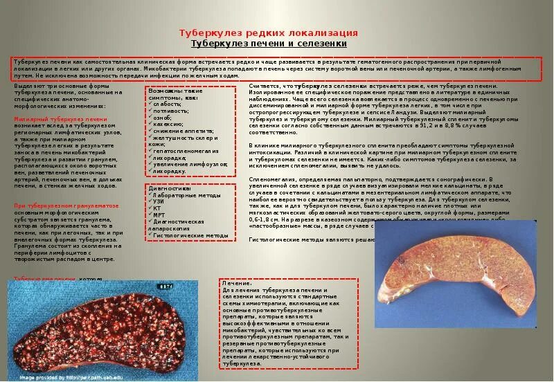 Туберкулез печени и селезенки.