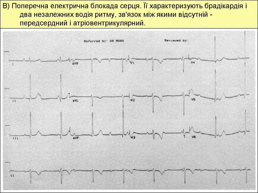 Что значит полная блокада. Полная поперечная блокада сердца ЭКГ. АВ блокада 2 ст Мобитц 1 и 2. Блокады проводящей системы сердца. Полная поперечная блокада на ЭКГ.