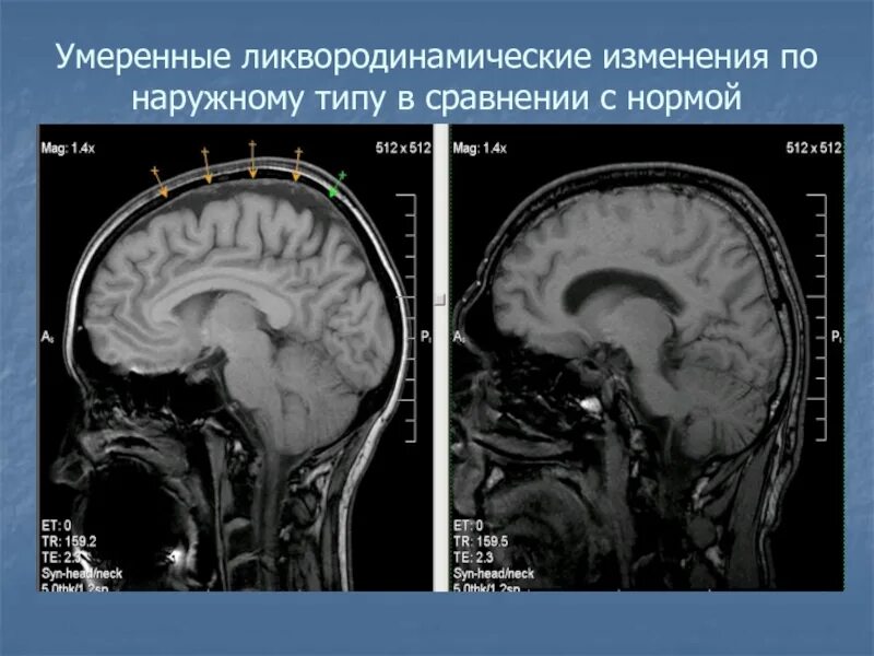 Изменение ликворокистозного характера. Заместительная наружная гидроцефалия кт. Гипертензивная гидроцефалия мрт. Рассеянный склероз гидроцефалия. Гидроцефалия головного мозга на кт.