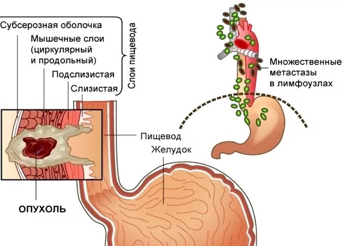 Опухоль желудка 4 стадия. Злокачественные новообразования пищевода. Степени онкологии желудка. Раковые опухоли в пищеводе. 4 стадия злокачественная