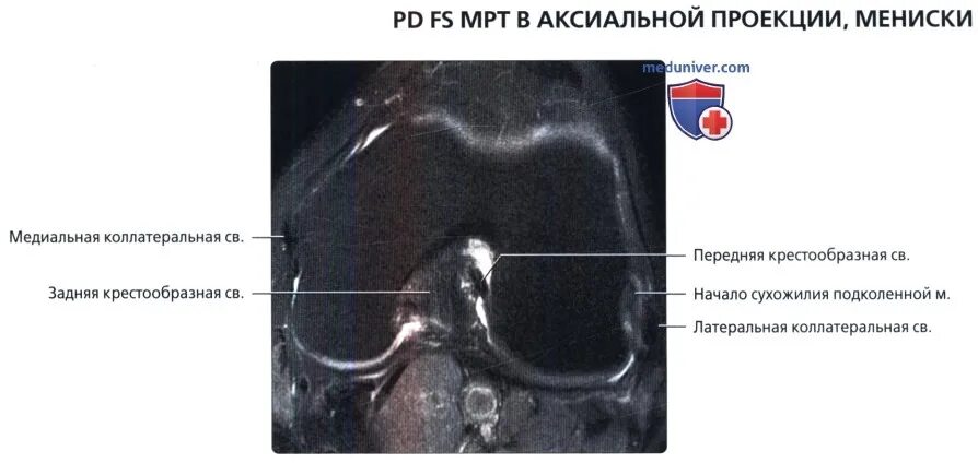 Повреждение мениска коленного сустава мрт. Повреждение медиального мениска мрт. Разрыв межменисковой связки на мрт. Дегенеративные изменения заднего рога медиального мениска 2