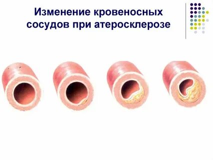 Определи изменения в сосудах