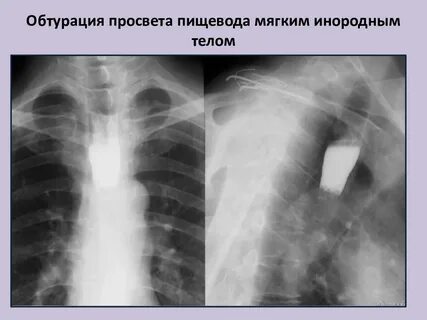 В грудной клетке инородное