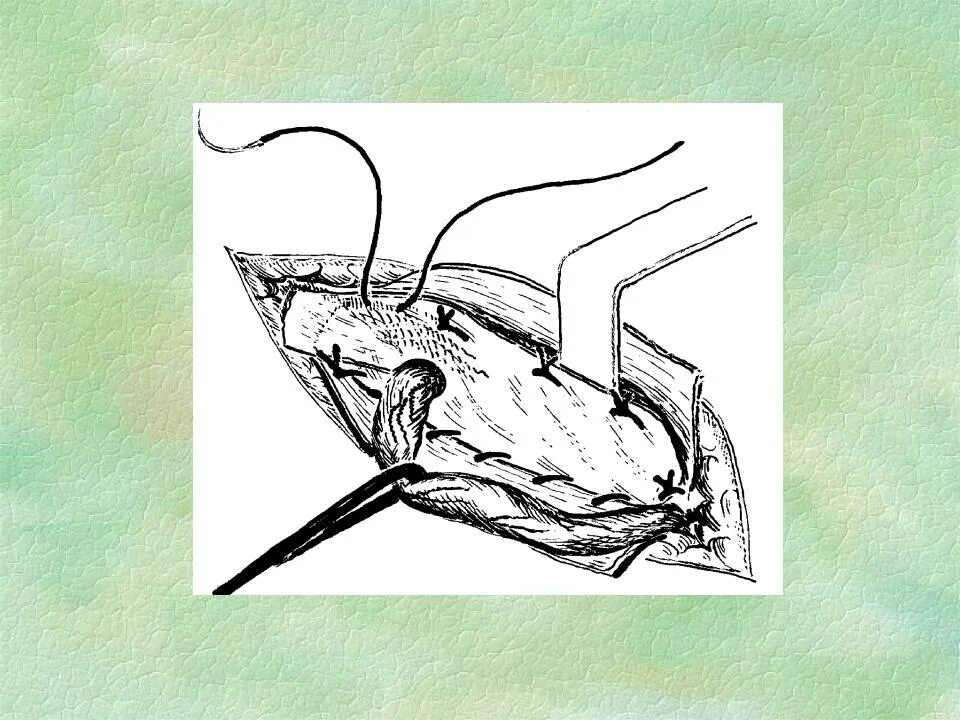 Грыжесечение по Лихтенштейну ход операции. Операция Лихтенштейна при паховой грыже схема. Операция грыжесечение пластика по Лихтенштейну. Герниопластика по Лихтенштейну. Лихтенштейн операция грыжа