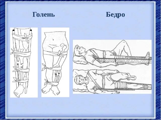 Перелом голени транспортировка. Перелом бедра транспортировка. Протяженность иммобилизации при переломе бедра. Транспортировка при ушибе бедра.