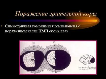 Поражение зрительных путей