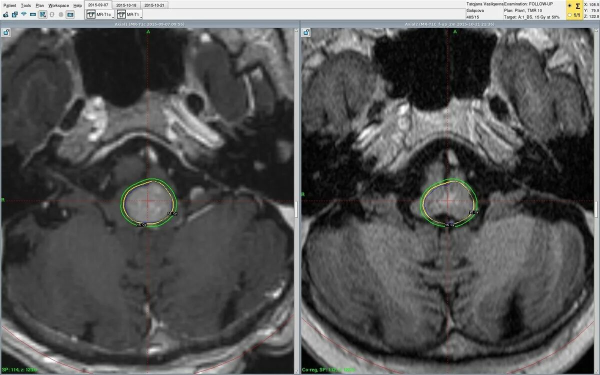 Метастазы в мозгу форум. Метастазы меланомы в головной мозг. Метастазы в головной мозг вскрытие. N2b метастазы. Как выглядит метастаз мозга в режиме т2.