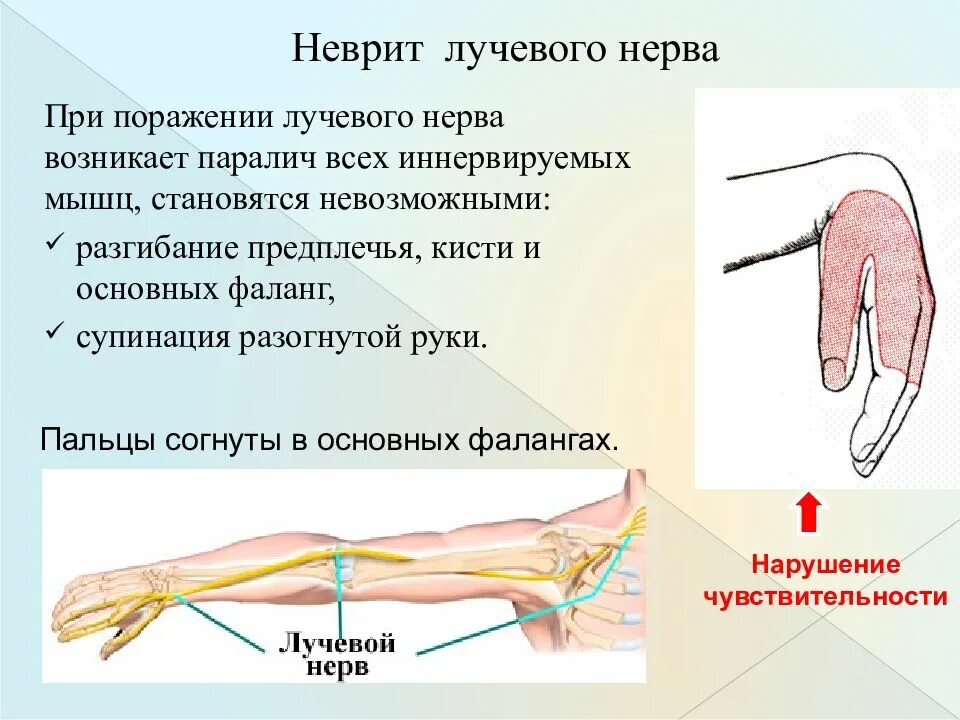 Нейропатия локтевого и лучевого нерва. Нейропатия лучевого нерва клиника. Диагностические тесты повреждения лучевого нерва. Проводниковая блокада лучевого нерва.