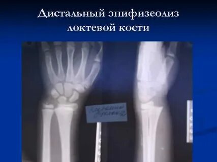 Дистальный эпифизеолиз