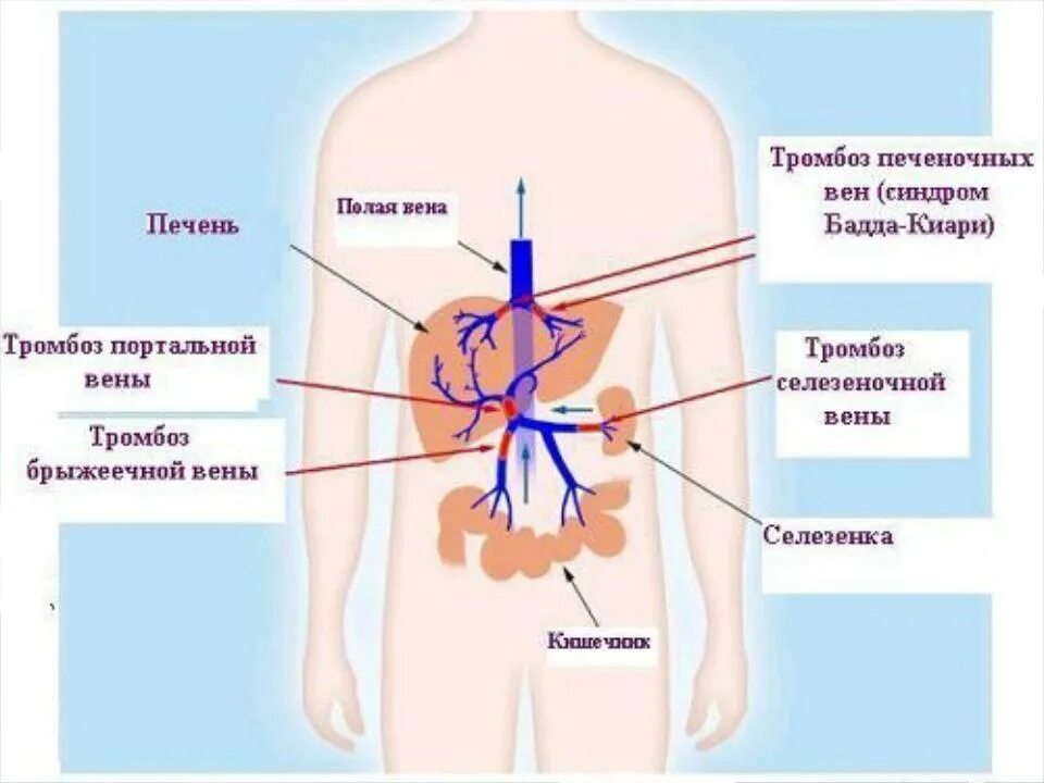 Тромб в печени. Тромбозы системы нижней полой вены. Тромбоз печеночных вен синдром Бадда-Киари. Синдром и болезнь Бадда Киари.