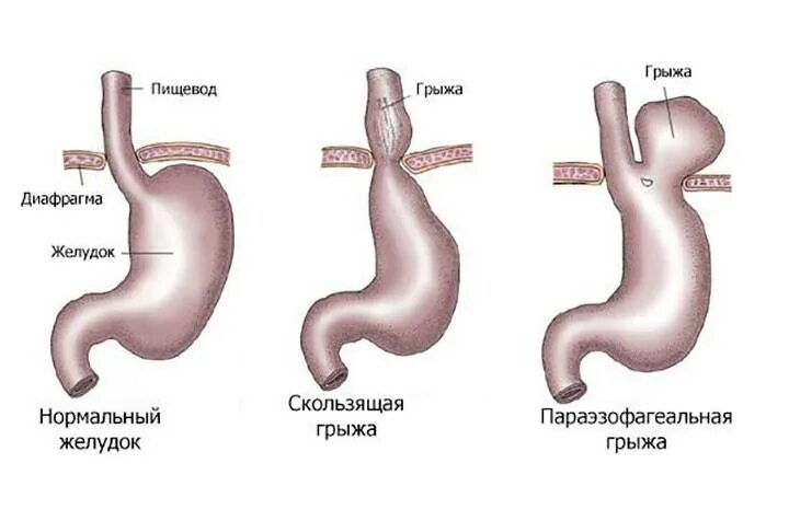 Грыжа под как лечить. Грыжа 2 степени желудка. Грыжа пищеварительного отверстия диафрагмы. Грыжа желудка 1 степени. Кардиальная грыжа пищевода.