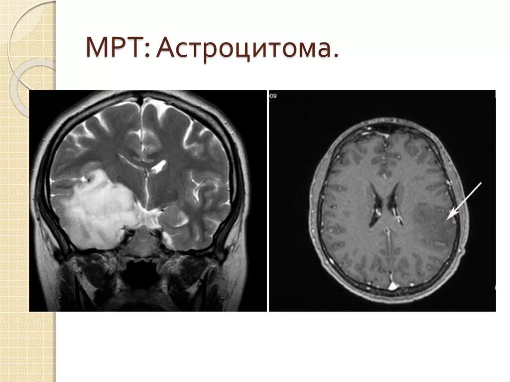 Диффузная астроцитома кт. Злокачественная астроцитома. Диффузная астроцитома мрт. Диффузная астроцитома