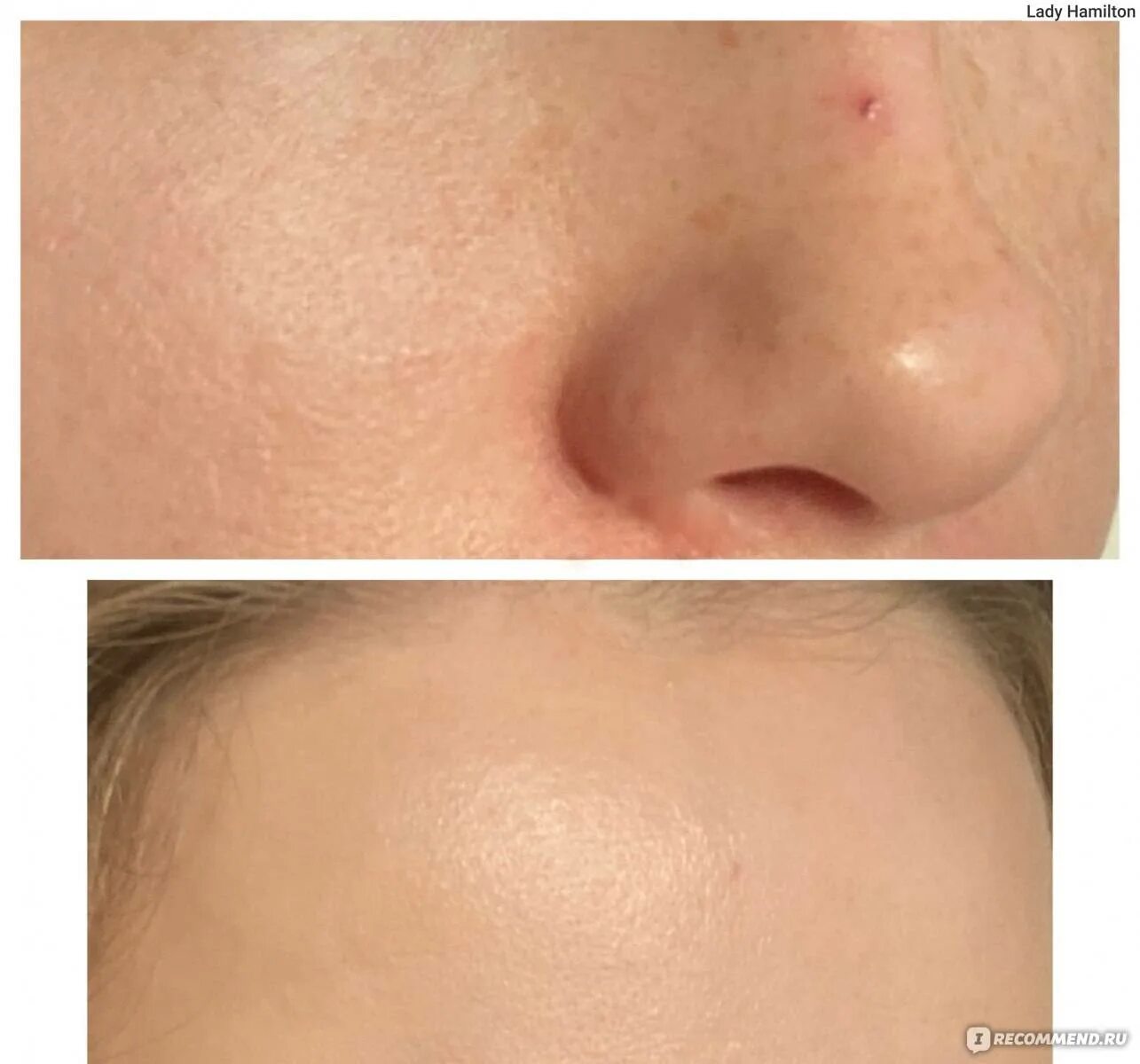 Как удалить звездочки на лице. Лазерная м22 сосудистве звёздочки. Сосудистые звездочки розацеа. Купероза, «сосудистые звездочки»?. Электрокоагуляция купероза.