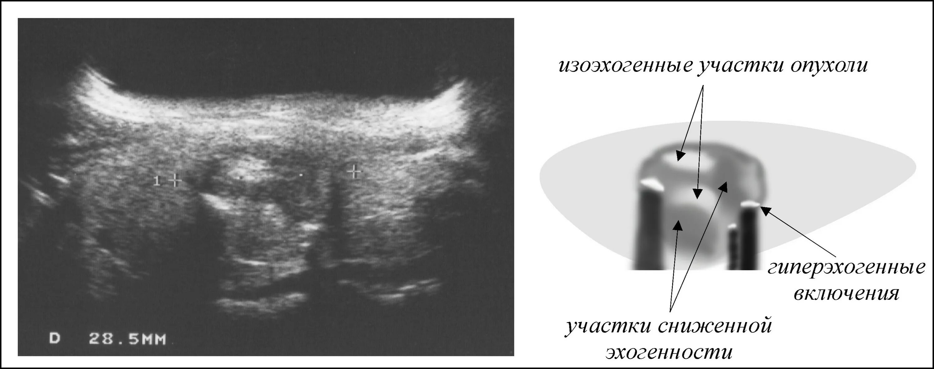 Пониженная эхогенность печени. Гиперэхогенный узел в щитовидной железе УЗИ. Эхогенность щитовидная железа на УЗИ. Анэхогенная структура УЗИ. Эхогенность предстательной железы на УЗИ.