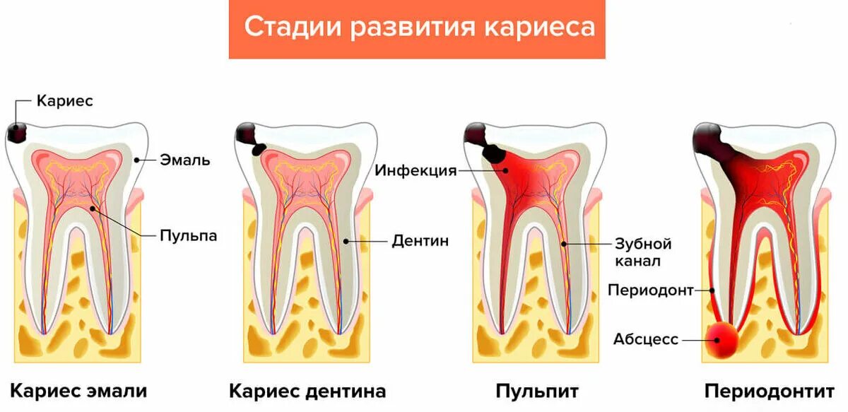 Почему больно зуб после лечения. Кариес эмали дентина и цемента. зубы кариес пульпит периодонтит.
