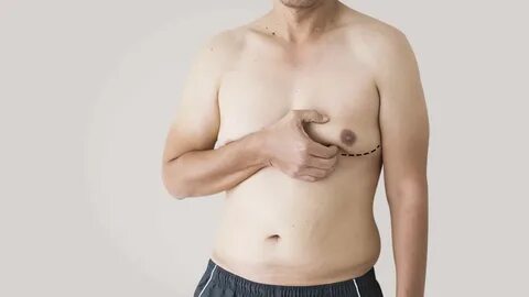 Gynecomastia or Man Boobs is an enlarged male chest tissue due to the hormo...