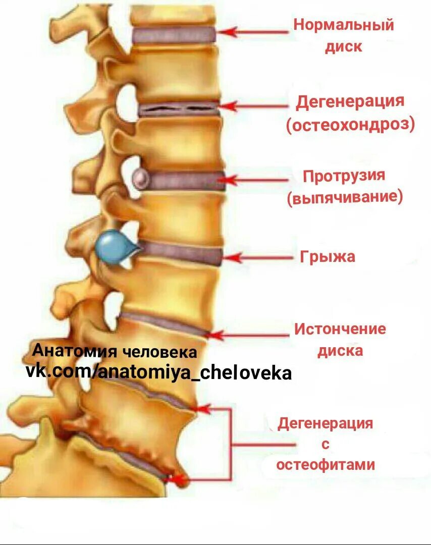 Спинные диски. Задние остеофиты позвонков поясничного отдела. Задние остеофиты позвонков с4-с5. Задние остеофиты l4-s1. Краевые остеофиты позвонков поясничного отдела.