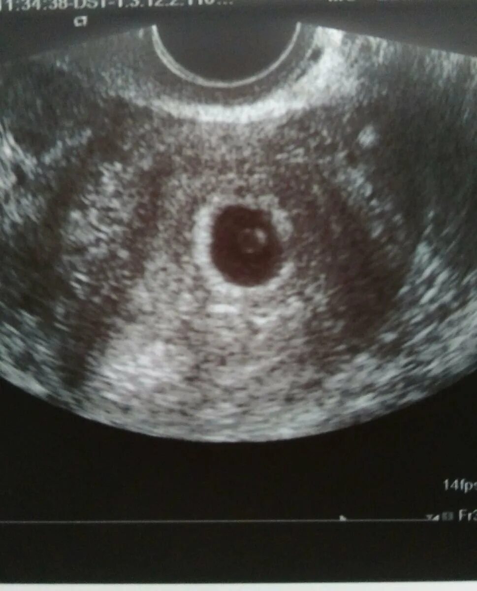 Как выглядит узи 5 недель. Как выглядит узи 5 недель. Как выглядит узи 5 недель. Беременность близнецами 5 недель узи. Плод на 5 неделе беременности узи.