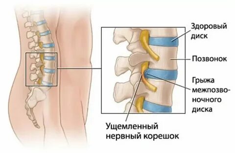Защемление в грудном отделе позвоночника лечение