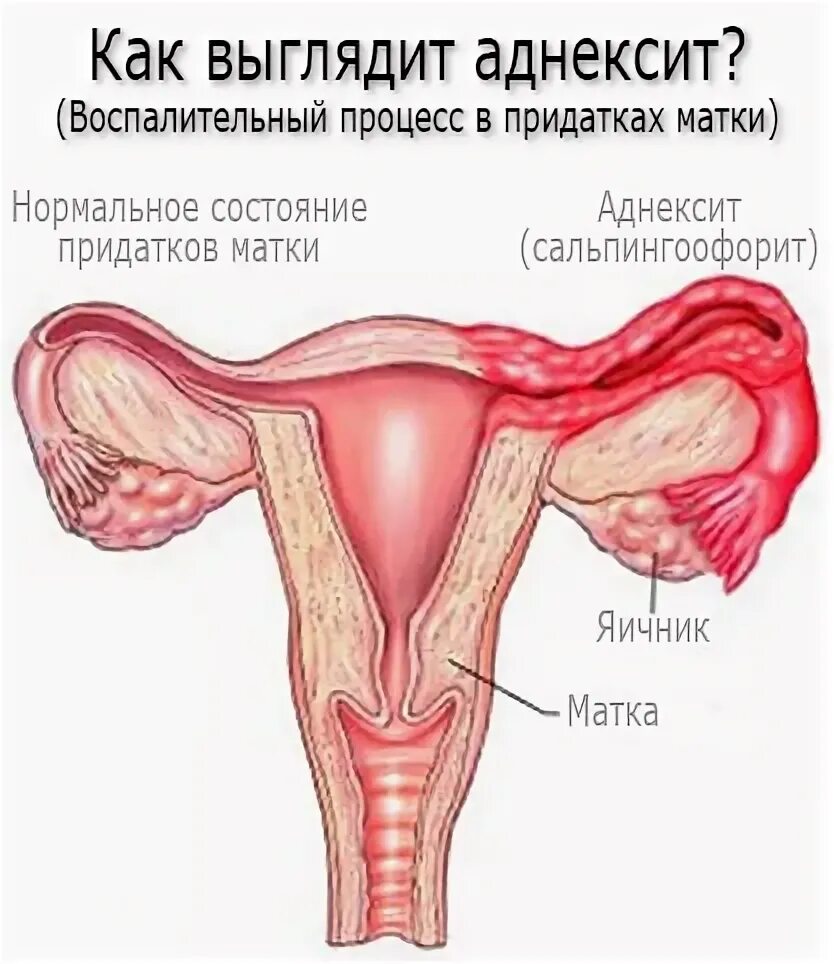 Воспаление придатков как называется