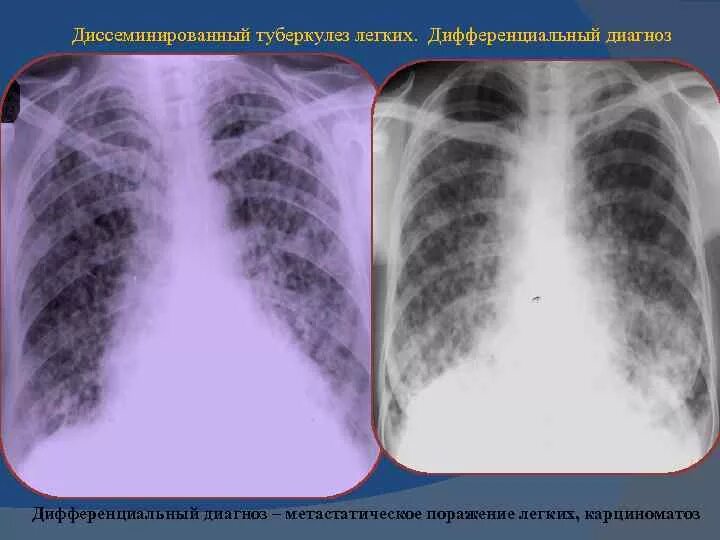 Диссеминированное поражение легких. Диссеминированный карциноматоз легких. Диагноз диссеминированный туберкулез легких. Диссеминированный саркоидоз кт. Метастатическое поражение легких.