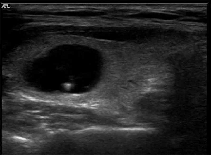 узи щитовидной железы узелки. узи признаки злокачественности узлов щитовидной железы. узи щитовидной железы узелки. атлас узи щитовидной железы. эхограммы узлы щитовидной железы.
