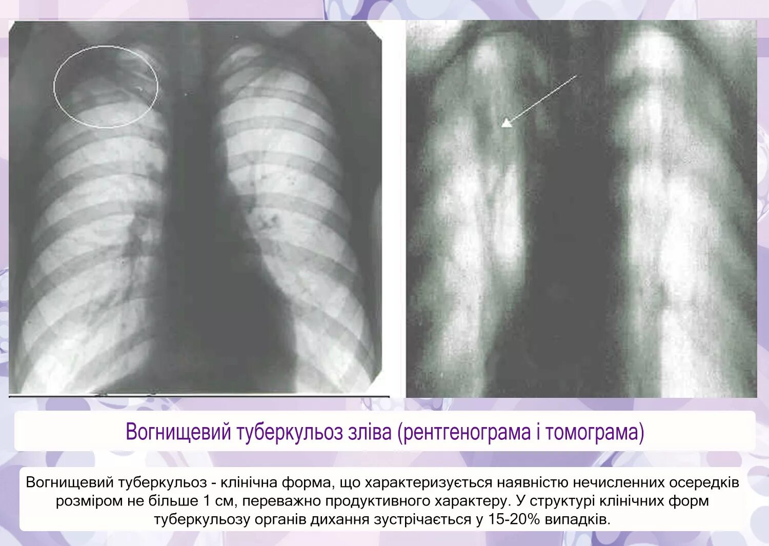 Туберкулез легкого рентгенограмма. Очаговый туберкулез рентген. Мягкоочаговый туберкулез рентген. Очаговый туберкулез рентген снимки. Очаговый туберкулез инфильтративный туберкулез.