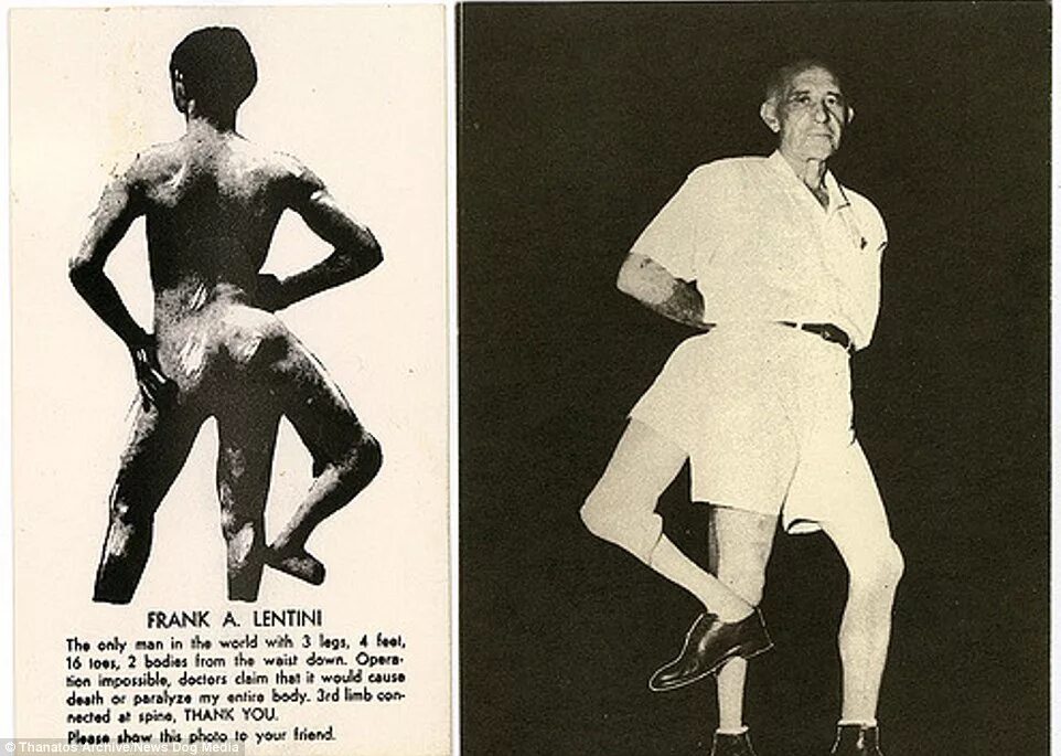 Видит три ноги. Фрэнк Лентини. Трехногий человек Франк Лантини. Фрэнк Лентини человек с тремя ногами. Фрэнк Лентини фото.